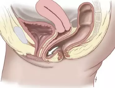 Anterior and Posterior Vaginal Repair