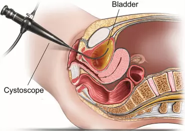 Cystoscopy