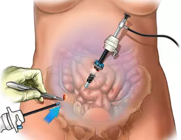 Laparoscopy