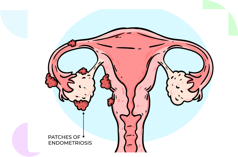 Endometriosis