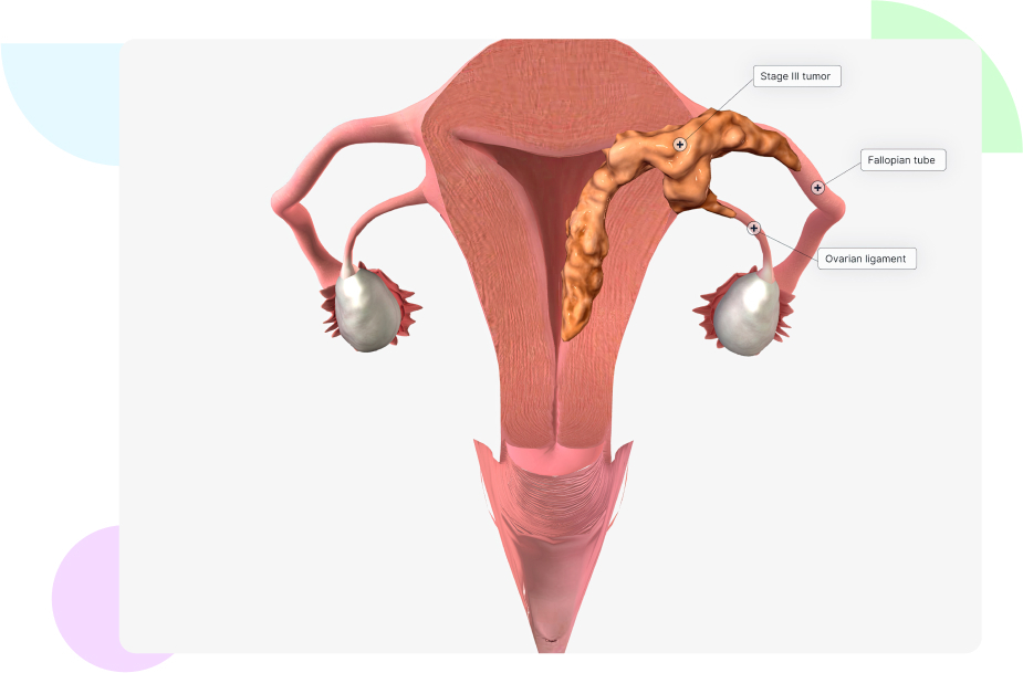 Hysterectomy