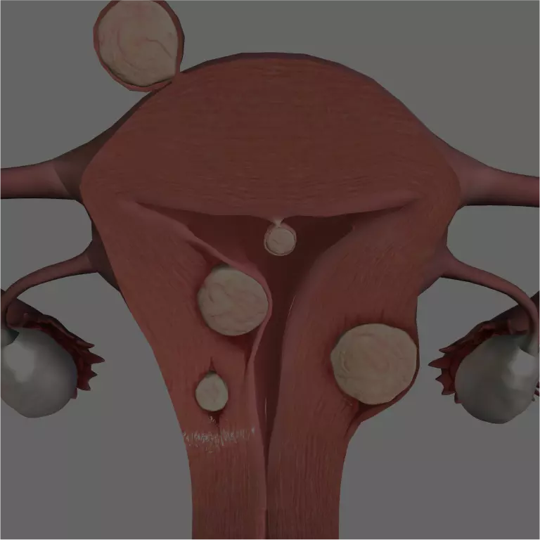 Uterine Fibroids